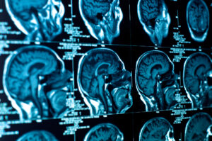 Brain Injury Lawyer Metairie, LA - Closeup of a CT scan with brain